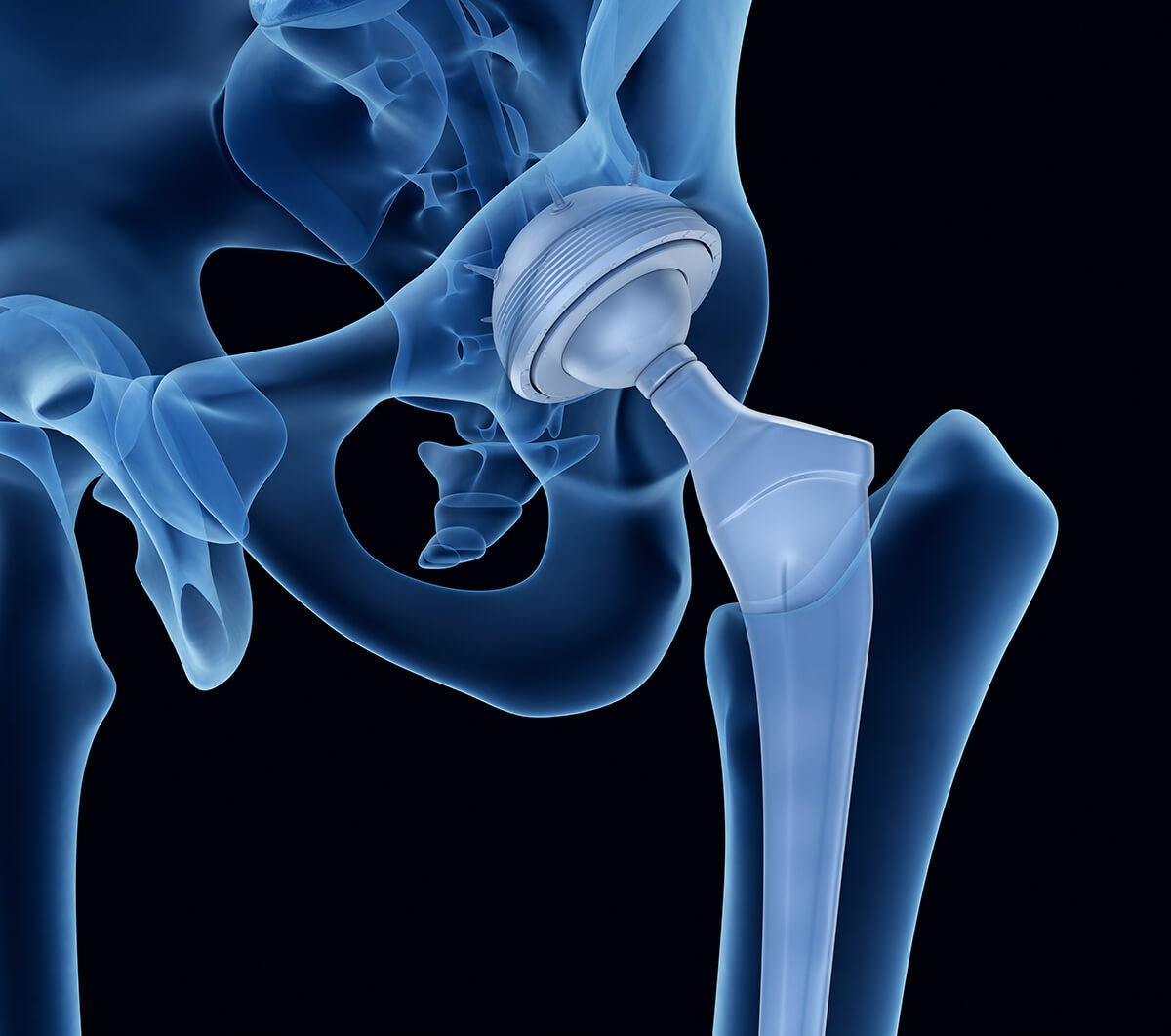 hip replacement x-ray image