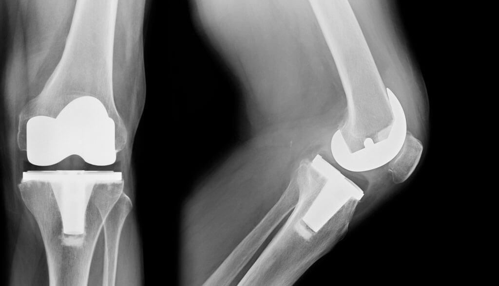 x-ray of knees with replacement hardware